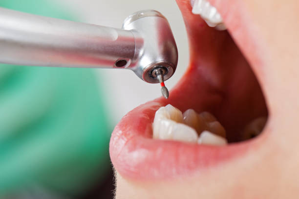 Best Chipped Tooth Repair Near Me  in Buckeye, AZ